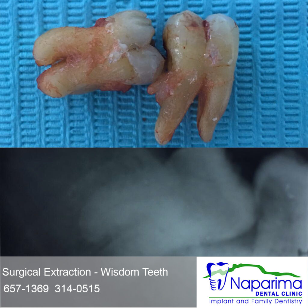 tooth teeth extraction molar impacted